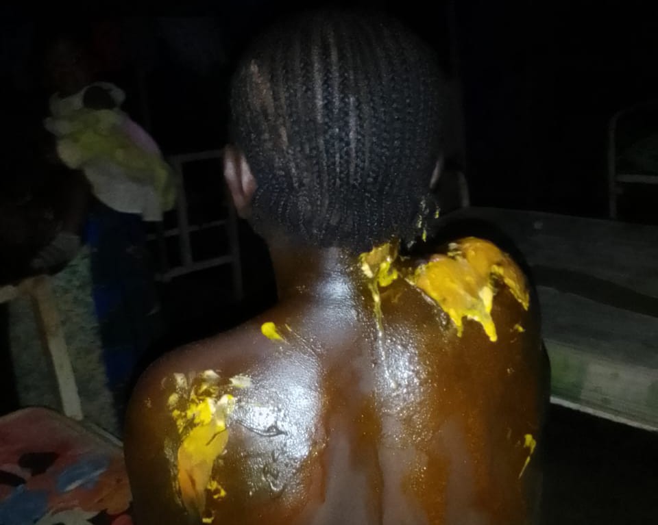 RDC : deux mineures brûlées à l’eau chaude après une dispute autour de 1.000 FC